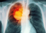 lung-cancer