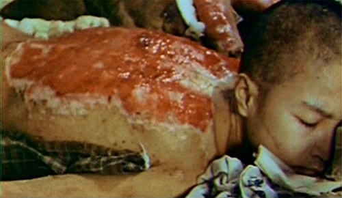 Sumiteru Taniguchi's back injuries from Nagasaki bombing, January 1946, by USMC 